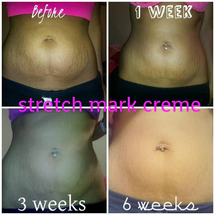 Anti-Stretch Mark Cream ( Original Import )