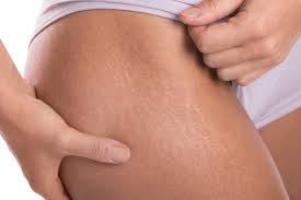 Anti-Stretch Mark Cream ( Original Import )